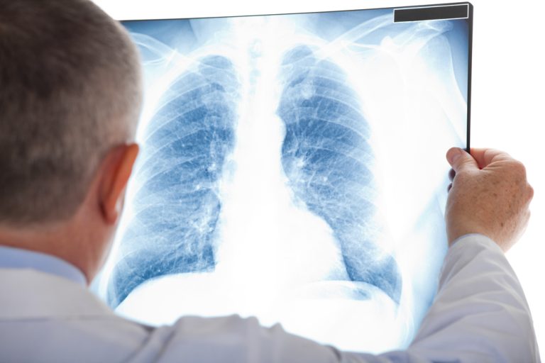 Ultrazvuky u praktických lékařů mohou významně pomoci covid pozitivním pacientům. "Odhalíme zápaly plic, které bychom jinak přehlédli," vysvětluje lékař Halata 1 lekar nemocnice plice covid