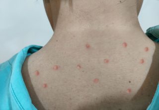 Nakažené opičími neštovicemi hlásí další země, většina je z Evropy. SZÚ má prý vše pod kontrolou